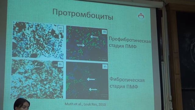 Патогенез первичного миелофиброза — клиническая и лабораторная практика | Лекториум смотреть онлайн