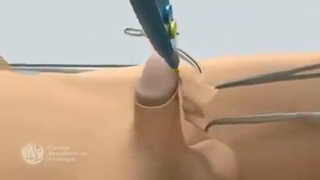 Circoncision!! Circumcision!! Chirurgie!! Medecin!! Info Doc!!