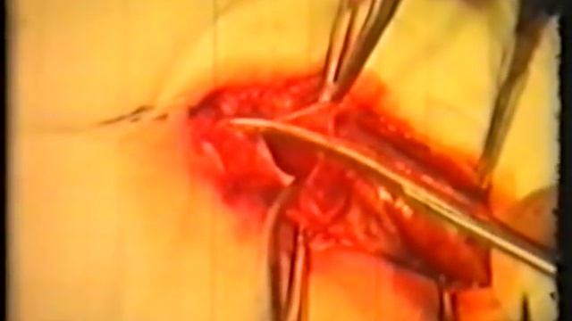 Герниотомия и герниопластика паховых грыж