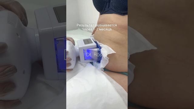Криолиполиз-похудение, быстро за один приём смотреть онлайн