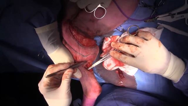Live stream - Recurrent mast cell tumour/genicular artery axial pattern flap/inguinal lymph node смотреть онлайн