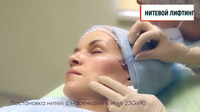 Нитевой лифтинг смотреть онлайн