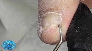 Вросший ноготь на ноге. Подногтевая мозоль удаление.