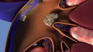 Удаление камня из почки.