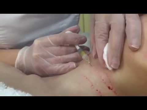 УБРАЕМ МОРЩИНЫ НА ШЕЕ - инъекции филлера Belotero Soft смотреть онлайн