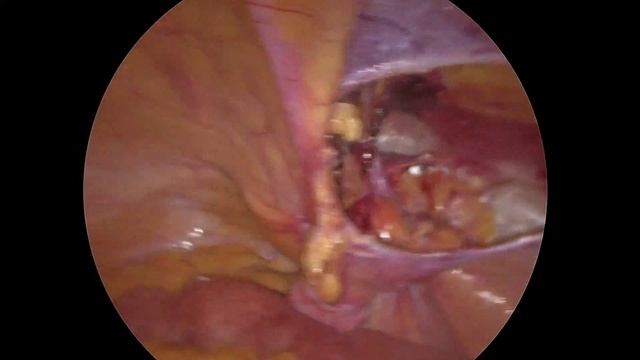 Лапароскопическая пластика двухсторонней паховой грыжи с использованием сетчатого протеза смотреть онлайн