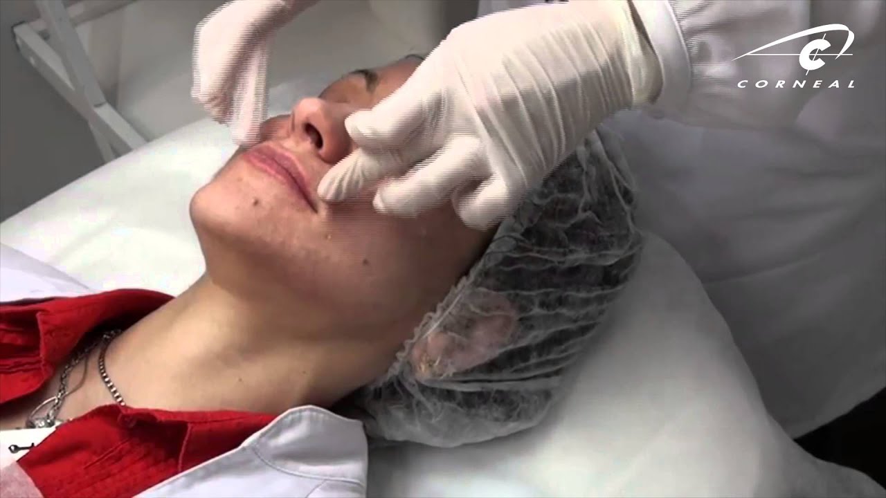 Различные техники биоревитализации