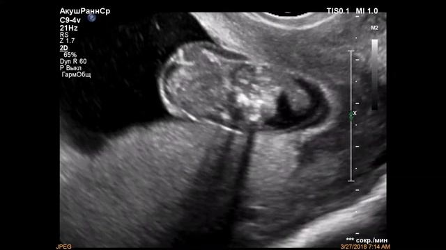 Экзэнцефалия/exencephaly смотреть онлайн