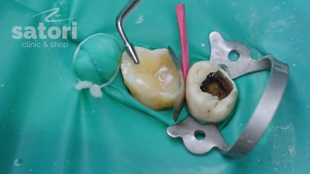 Восстановление зуба пломбой – стоматология Самара смотреть онлайн