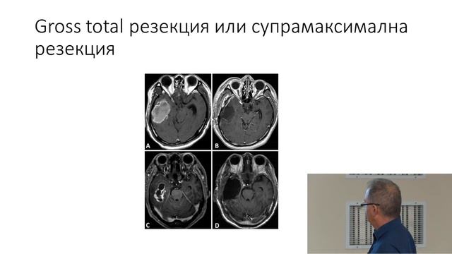 High-grade glioma surgery смотреть онлайн