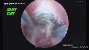 Гистероскопия удаление полипа из полости матки