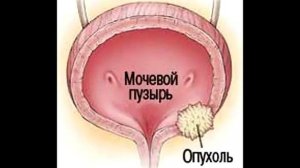 Малозаметные признаки рака мочевого пузыря, которые часто упускают