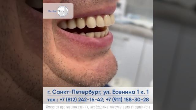 Ответ на комментарий! Развеем миф о долговечности методики все на 4 и ProArch. смотреть онлайн