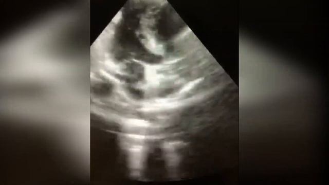 90. Асимметричная ГЛЖ и аневризмы ПМЖА. смотреть онлайн