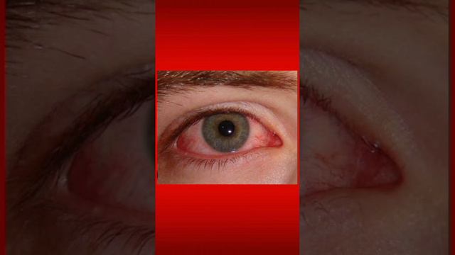 Aconite for Conjunctivitis #drprashna #viral #trending #homeopath #shortvideo смотреть онлайн