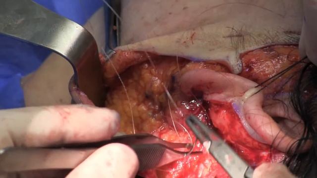 Part 5/7: SMAS Tightening Facelift | Vancouver Facelift Surgery with Dr. Buonassisi in Vancouver BC смотреть онлайн