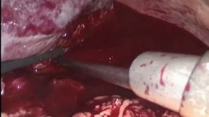 Травма селезенки, лапароскопическая спленэктомия