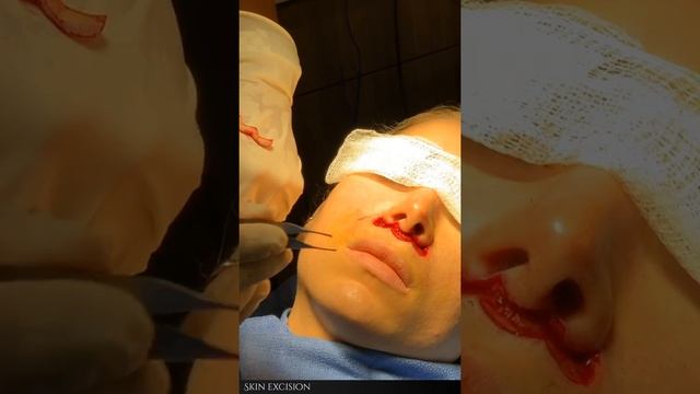 The Subnasal lip lift, Bullhorn lip lift, Upper lip lift by Dr. Anurag Agarwal смотреть онлайн