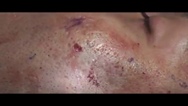 Acne Scar Revision Part Four More Subcision Technique by Dr Young Bellevue, WA YouTube смотреть онлайн