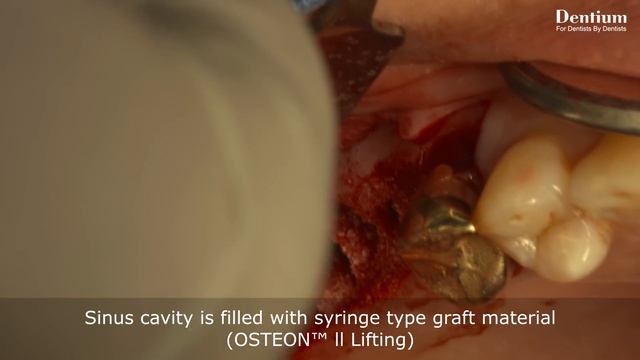 Sinus Lifting Using Dentium Advanced Sinus Kit