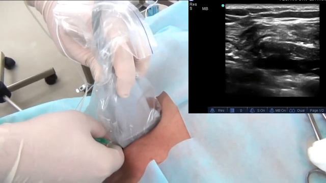 Подключичная блокада плечевого сплетения с катетеризацией смотреть онлайн