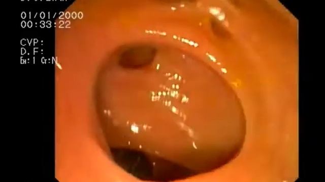 Дивертикулез сигмовидной кишки смотреть онлайн