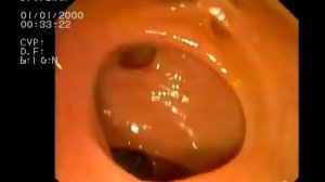 Дивертикулез сигмовидной кишки