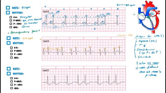 Rate and Rhythm | Premature Atrial Contraction (PAC) смотреть онлайн