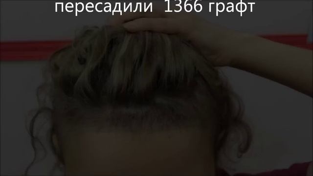 Две недели после пересадки VOLLOSY.KZ смотреть онлайн