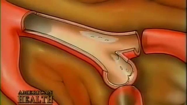 Dr Ignarro - Health Benefits Of Arginine & Citrulline (1) смотреть онлайн