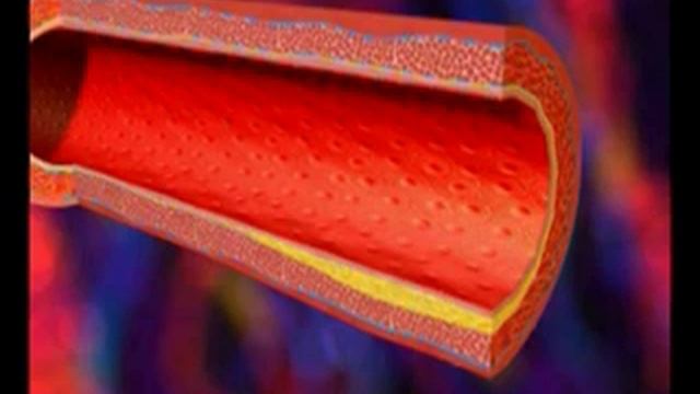 Infarct miocardic смотреть онлайн