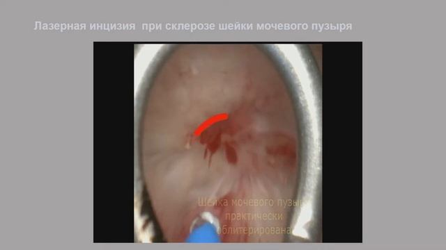 3 Опыт применения хирургического лазера в урологическом центре РЖД Медицина Новосибирск смотреть онлайн