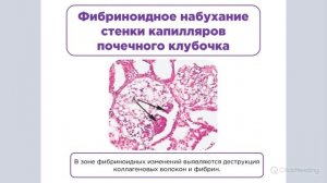 Стромально-сосудистые дистрофии | Патологическая анатомия