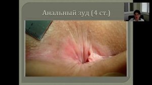 "Зуд в Заднем Проходе", вебинар 04.07.2015