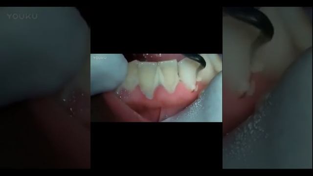 Ultrasonic Tooth Cleaner Review смотреть онлайн