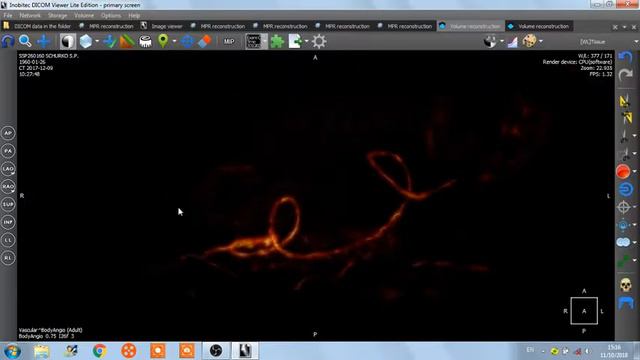 Гастроепиплюэка декстра , чревный ствол смотреть онлайн