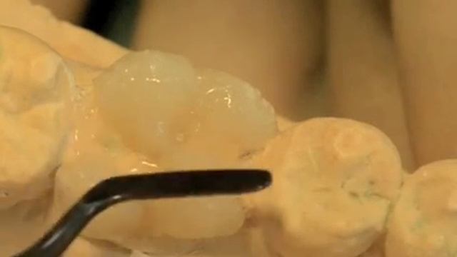 композитная реставрация 36 на модели, тренировка.m4v смотреть онлайн