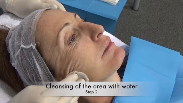 意大利 PQAGE TCA peel 緊緻煥膚療程 смотреть онлайн