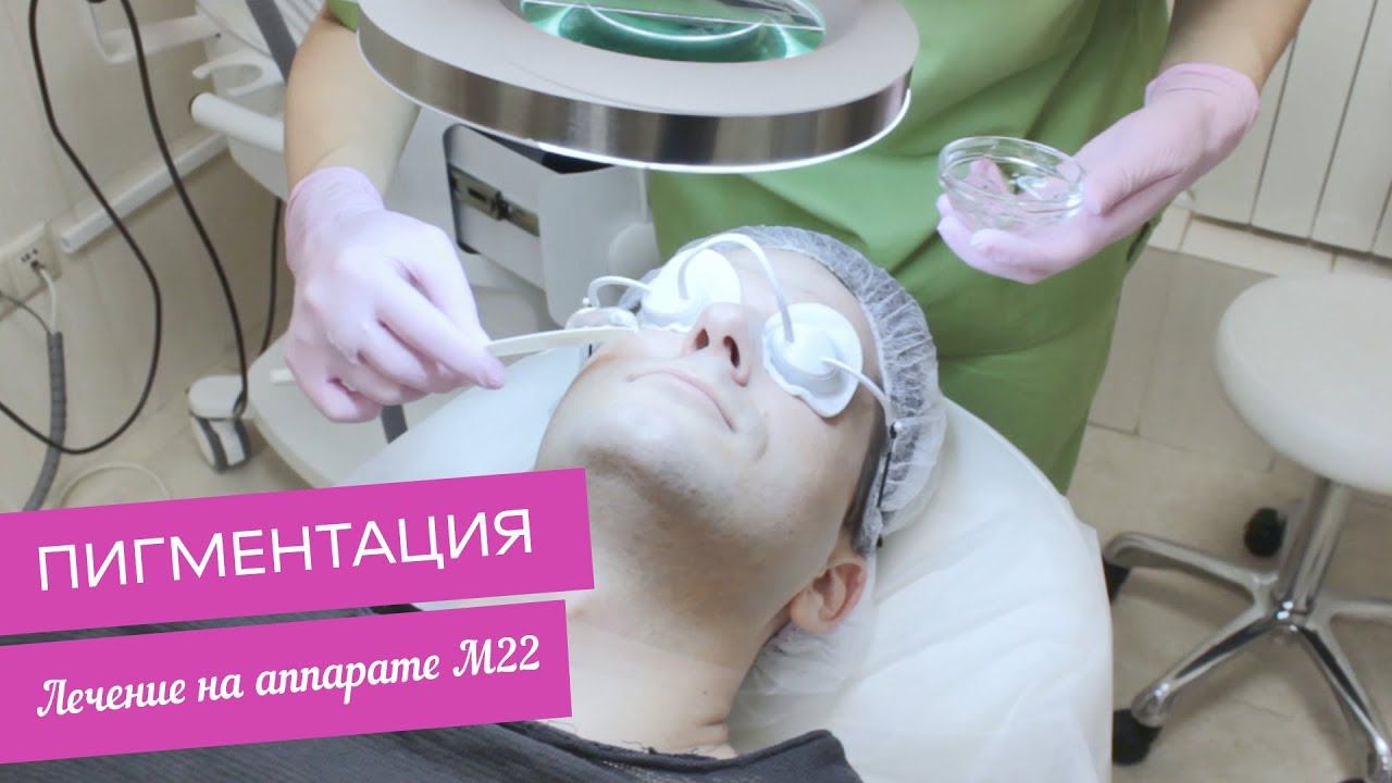 Лечение пигментации у мужчин на аппарате М22 смотреть онлайн