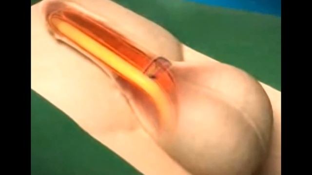 Анимация протезирования гидравличнским пенильным имплантатом смотреть онлайн