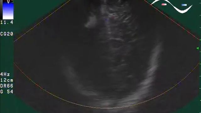 Детская Нейросонография (УЗИ головного мозга) - Образование теменной области головного мозга смотреть онлайн