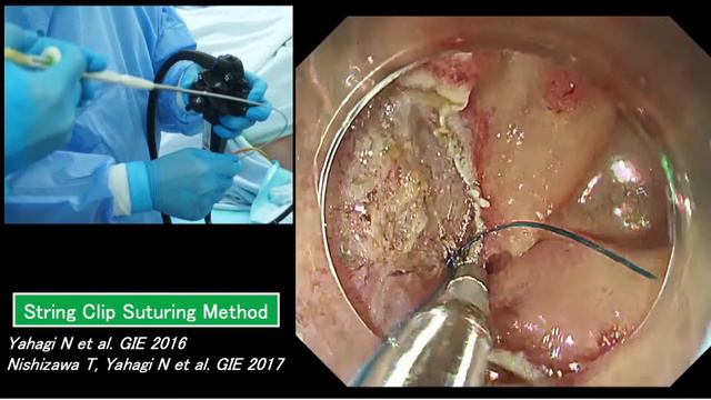 Tips and Tricks for ESD: Prevention and management of perforation- string clip suturing method смотреть онлайн