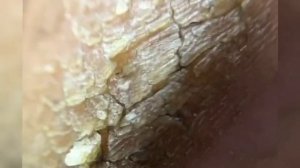 Трещины на пятках. Как избавиться от трещин?