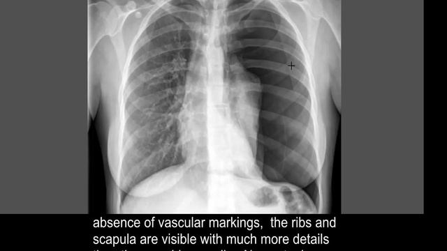 Chest x-ray - Pneumothorax or no pneumothorax смотреть онлайн