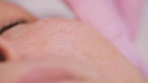 Фотоомоложение лица (процедура, до и после)