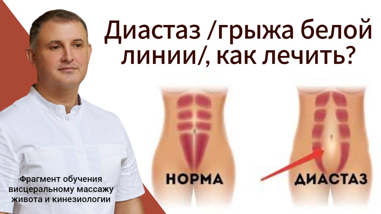 Диастаз /грыжа белой линии/, как лечить? Фрагмент обучения массажу живота и кинезиологии