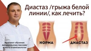 Диастаз /грыжа белой линии/, как лечить? Фрагмент обучения массажу живота и кинезиологии
