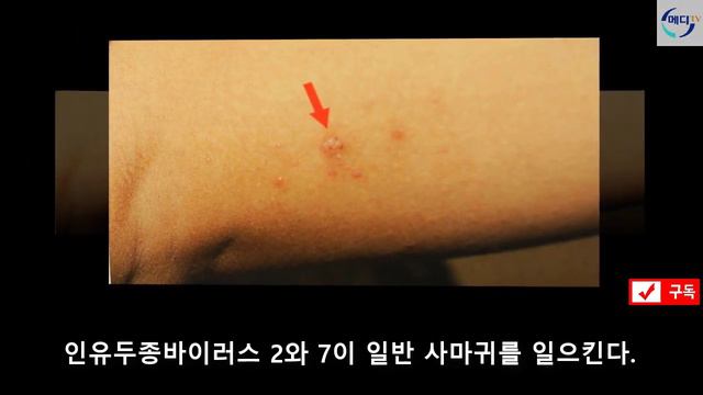 인유두종바이러스는 무엇일까 ? ● 건강 TV매일 ● 【경악】 смотреть онлайн