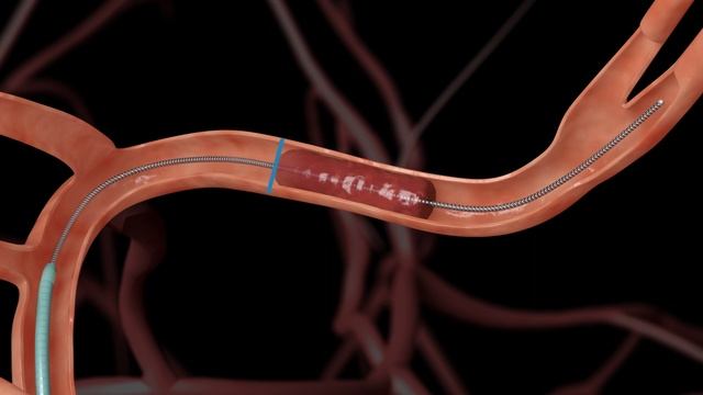 Solitaire™ Platinum Revascularization Device смотреть онлайн