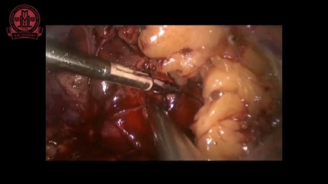 Ретроперитонеоскопическая резекция опухоли левой почки смотреть онлайн